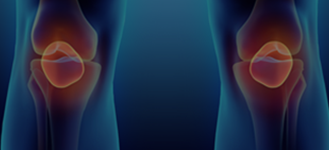 Stem Cell Injections for Meniscus Tear